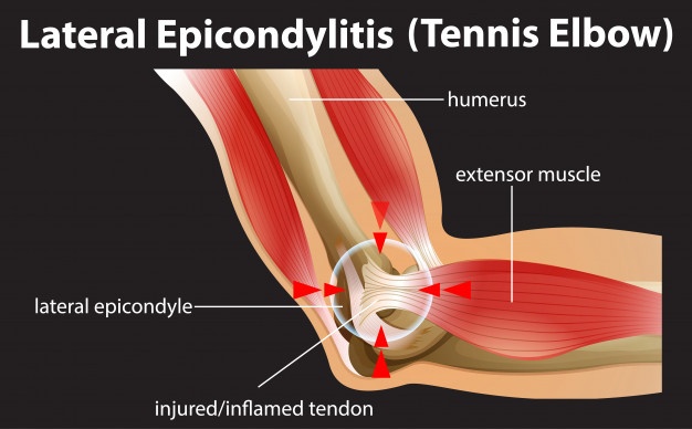 How to sleep with tennis elbow